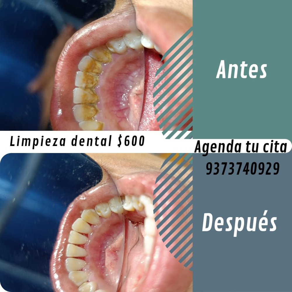 Limpieza dental: dientes con sarro antes y limpios después del tratamiento