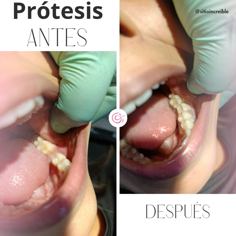 Prótesis dental: antes y después del tratamiento