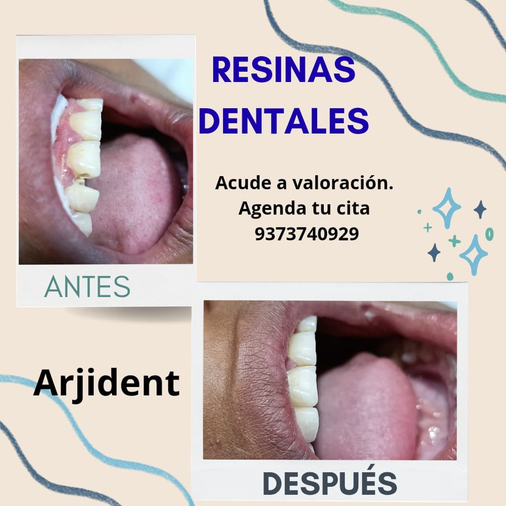 Resinas dentales: diente fracturado antes y reparado después