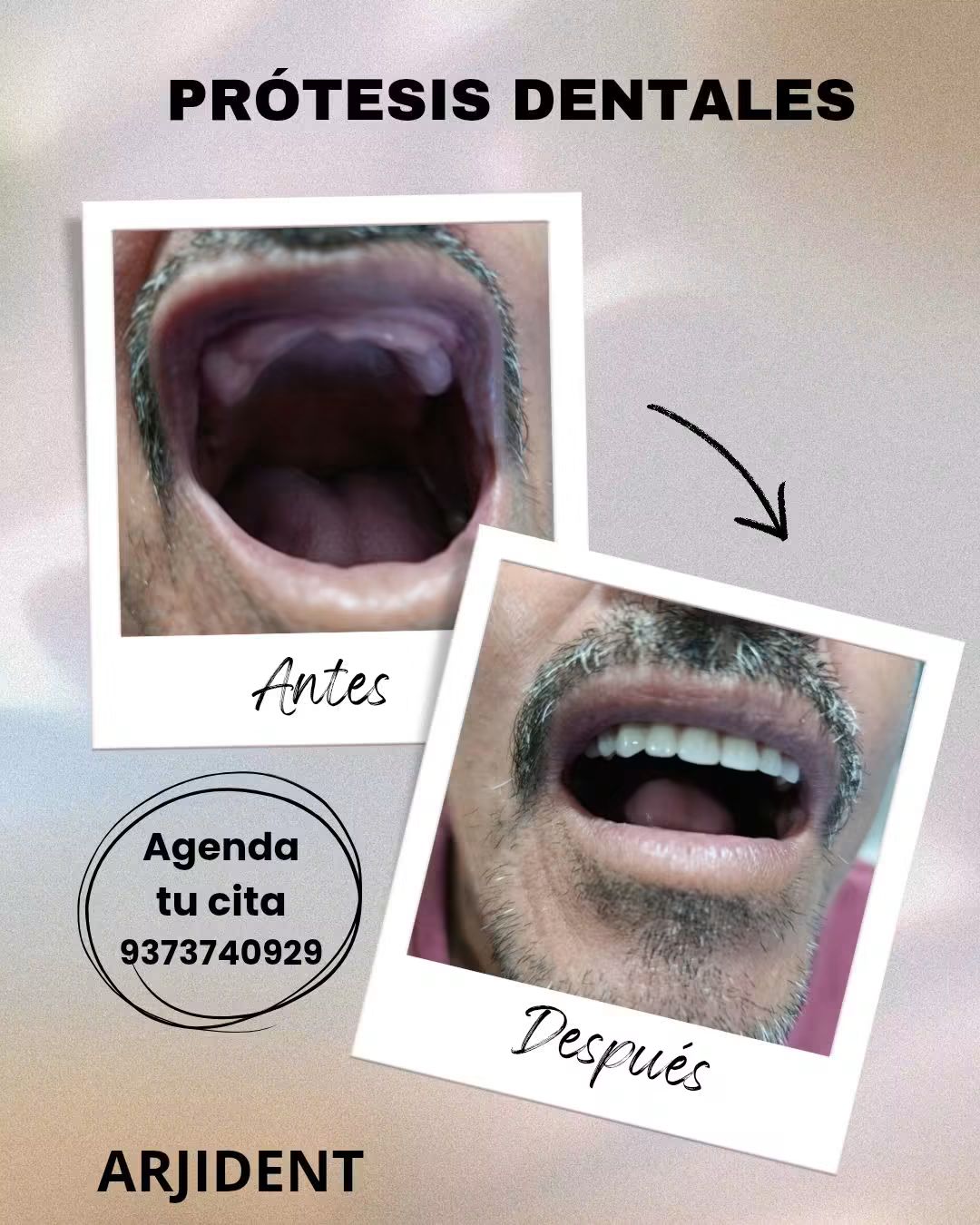 Prótesis dental: foto de la boca antes y después del tratamiento